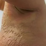 granular-parakeratosis-02__protectwyjqcm90zwn0il0_focusfillwzi5ncwymjisingildfd-7481948-6295309-jpg-9592901