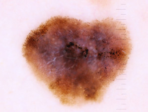 Dermatoscopia invasiva de melanoma, Breslow 0,4 mm dentro de un melanoma in situ, con presencia de nevo asociado