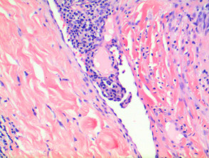 Patología del sarcoma de Kaposi