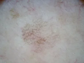 Patrón granular anular visto en dermatoscopia de queratosis similar a liquen plano