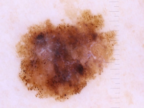 Dermatoscopia in situ del melanoma