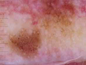 Dermatoscopia de lentigo maligno