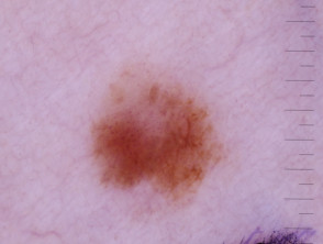 Dermatoscopia in situ de melanoma
