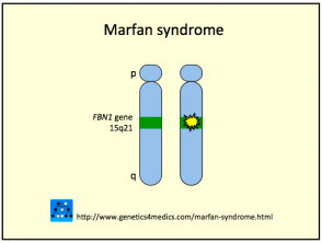 síndrome de Marfan