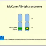 mccune-albright-sindrome__protectwyjqcm90zwn0il0_focusfillwzi5ncwymjisingildfd-6667091-6399682-png-7848317