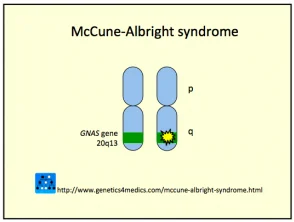 Sindrome di McCune Albright