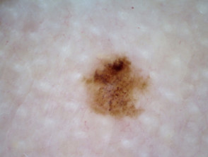 Melanoma in situ 13 dermatoscopia
