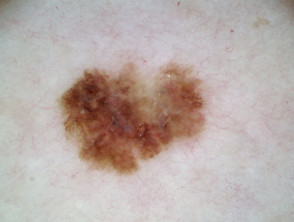 Melanoma in situ 10 dermatoscopia