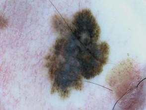 Dermatoscopia de melanoma in situ 9