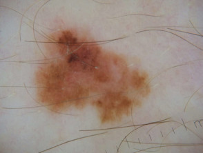 Dermatoscopia de melanoma in situ 7