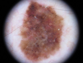 Melanomía in situ 4 dermatoscopia
