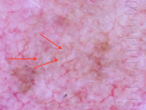 Círculos concéntricos (flechas rojas) observados en la dermatoscopia de lentigo maligno