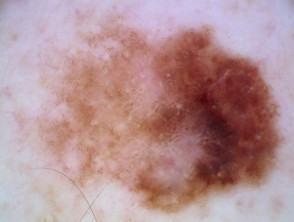 Melanoma in situ en colisión con un nevus dérmico benigno