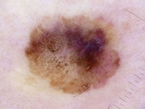 Melanoma de extensión superficial in situ que surge de un nevus atípico