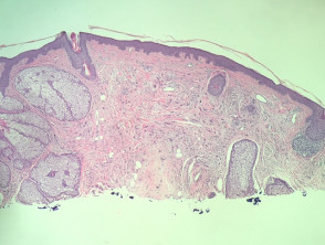 neurofollicular-hamartoma-figure-1__protectwyjqcm90zwn0il0_focusfillwzi5ncwymjisinkildiyxq-6137851-3282962-jpg-2223190