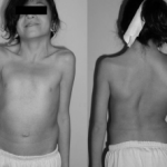 noonan-syndrome__protectwyjqcm90zwn0il0_focusfillwzi5ncwymjisinkilde0xq-8929211-7593414-png-2382636