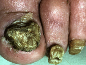 Onicogrifosis, uña del pie