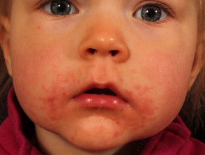Periorifizielle Dermatitis bei einem Kind