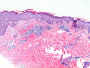 Pemphigus foliaceus Pathologie