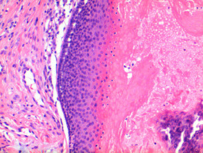 Patología del pilomatricoma