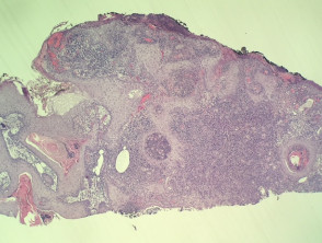 pseudocarcinomatous-hyperplasia-in-anaplastic-large-cell-lymphoma-figure-1__protectwyjqcm90zwn0il0_focusfillwzi5ncwymjisingildiwxq-5339185-1960767-jpg-5779788