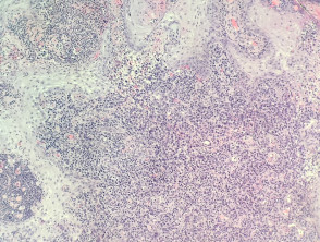 Hiperplasia pseudocarcinomatosa en linfoma anaplásico de células grandes