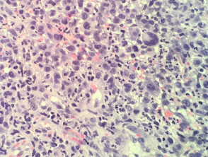 Hiperplasia pseudocarcinomatosa en linfoma anaplásico de células grandes