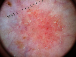 Vista dermatoscópica de la psoriasis