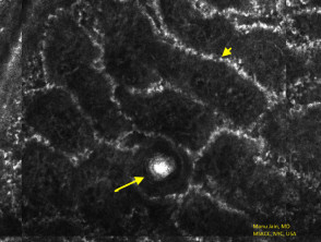 Microsopia confocal de reflectancia de la queratosis benigna en la unión dermoepidérmica