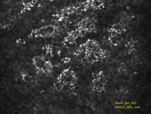Microscopía confocal de reflectancia del patrón de adoquines suprabasales de queratosis benigna