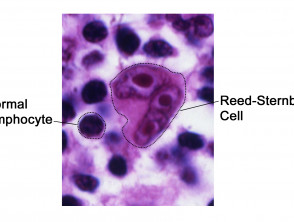 reed-sternberg-lymphocyte-nci-vol-7172-300__protectwyjqcm90zwn0il0_focusfillwzi5ncwymjisingildi2xq-9487505-6789555-jpg-7744669