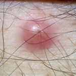 reticoloistiocitoma__protectwyjqcm90zwn0il0_focusfillwzi5ncwymjisingildfd-8995859-3422022-jpg-8790941