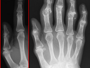 Röntgenfoto van knobbeltjes in Heberden en Bouchard