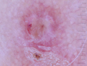 Vasos de asa observados en la dermatoscopia de carcinoma de células escamosas