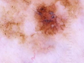 Dermatoscopia de melanoma de extensión superficial