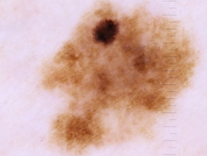 Demoscopia in situ de melanoma de extensión superficial