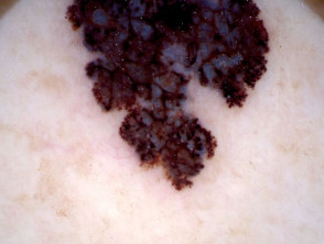 Dermatoscopia de melanoma de extensión superficial