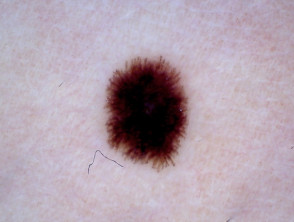 Spitz nevus (pigmentado) 4 dermatoscopia