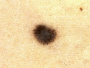 Spitz nevus (pigmentado) 3 dermatoscopia