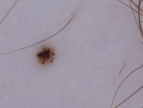Dermatoscopia del nevus de Spitz (pigmentado)