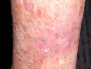 Carcinoma de células basales superficial, pierna