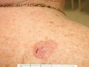 Carcinoma superficial de células basales, hombro