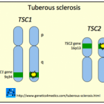 tuberous-sclerosis__protectwyjqcm90zwn0il0_focusfillwzi5ncwymjisingildfd-9963235-6401905-png-2801068
