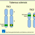 sclerosi-tuberosa__protectwyjqcm90zwn0il0_focusfillwzi5ncwymjisingildfd-9963235-6401905-png-2801068