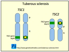 sclerosi-tuberosa__protectwyjqcm90zwn0il0_focusfillwzi5ncwymjisingildfd-9963235-6401905-png-2801068