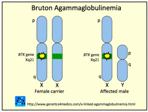 Agammaglobulinemia ligada a X