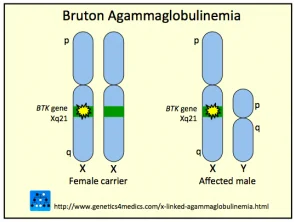 Agammaglobulinemia legata all'X