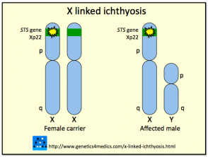 Ictiosis ligada al cromosoma X