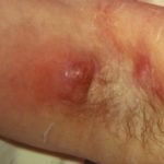 abscess-1__protectwyjqcm90zwn0il0_focusfillwzi5ncwymjisingildfd-9038435-7865254-jpg-2926982
