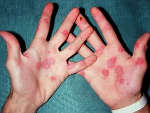 Unerwünschte Hautreaktion auf Antikonvulsiva, Erythema multiforme Zielläsionen